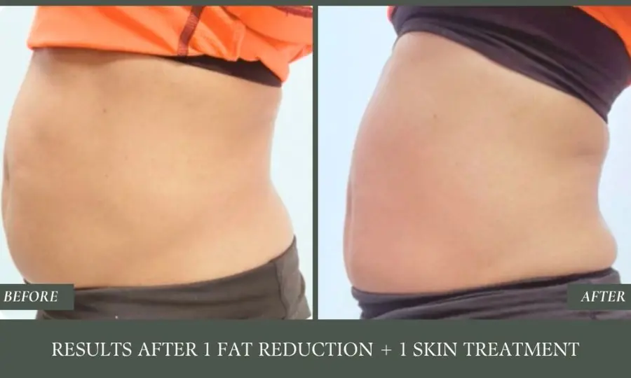 Before and after a fat reduction and skin treatment.