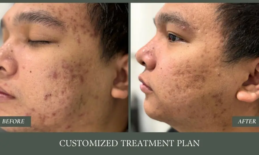 Before and after comparison: customized treatment plan.