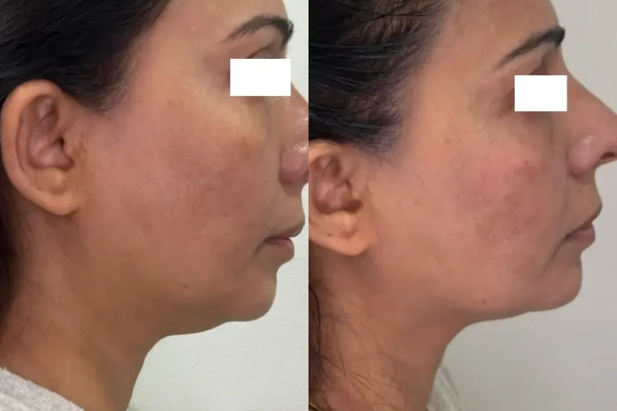 Before (left) and after (right) of a XERF non-surgical facelift.