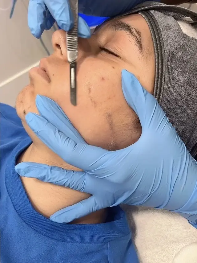 Dermaplaning in progress at Skinholic Aesthetics & Laser.