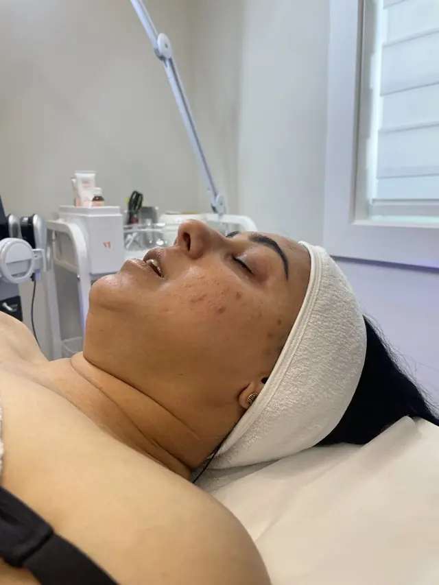 Skin Tightening at Skinholic Aesthetics & Laser, in the treatment room