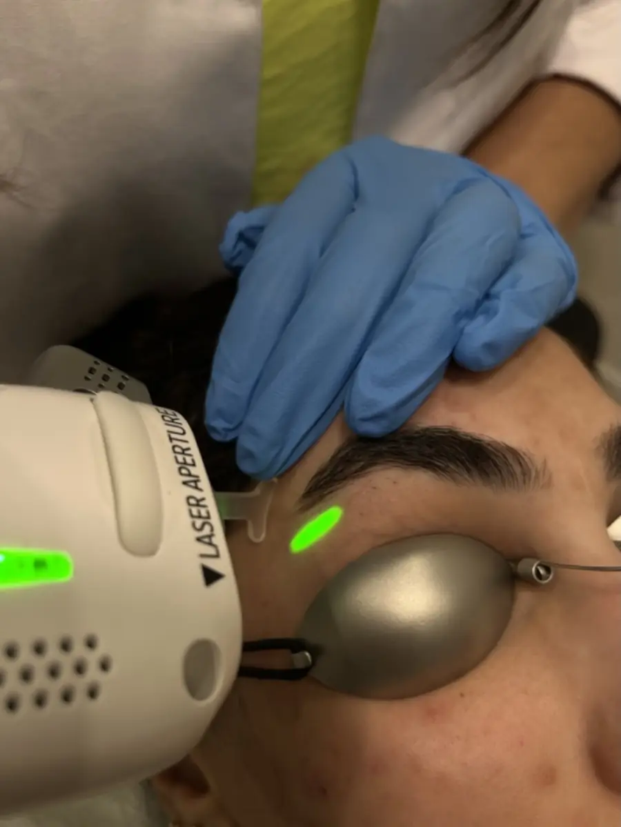 Triple Wavelength LHR at Skinholic Aesthetics & Laser in Aldergrove.