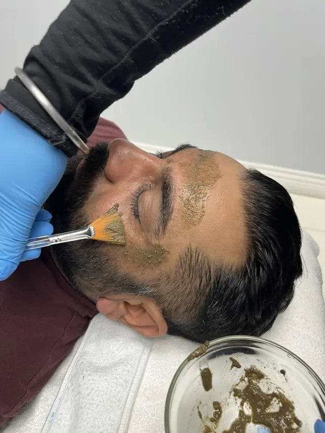 Peels in progress at Skinholic Aesthetics & Laser.