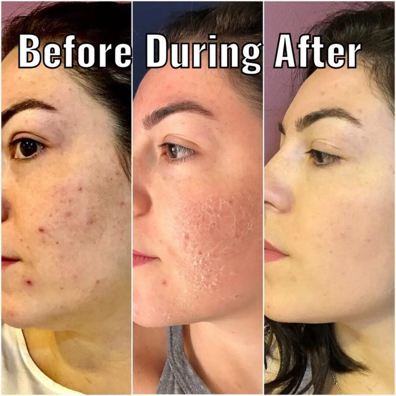 Before, during and after a peel treatment at Skinholic.