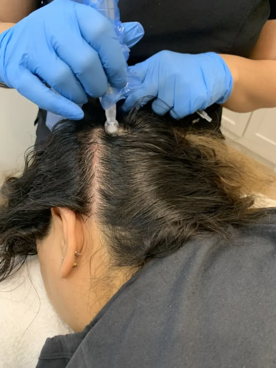 Scalp treatments in progress at Skinholic Aesthetics & Laser.