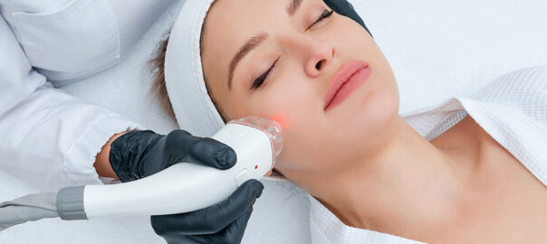 laser hair removal on face