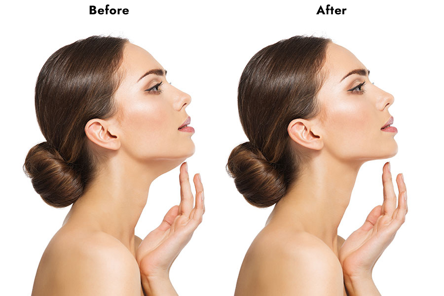 Double Chin Surgery of women