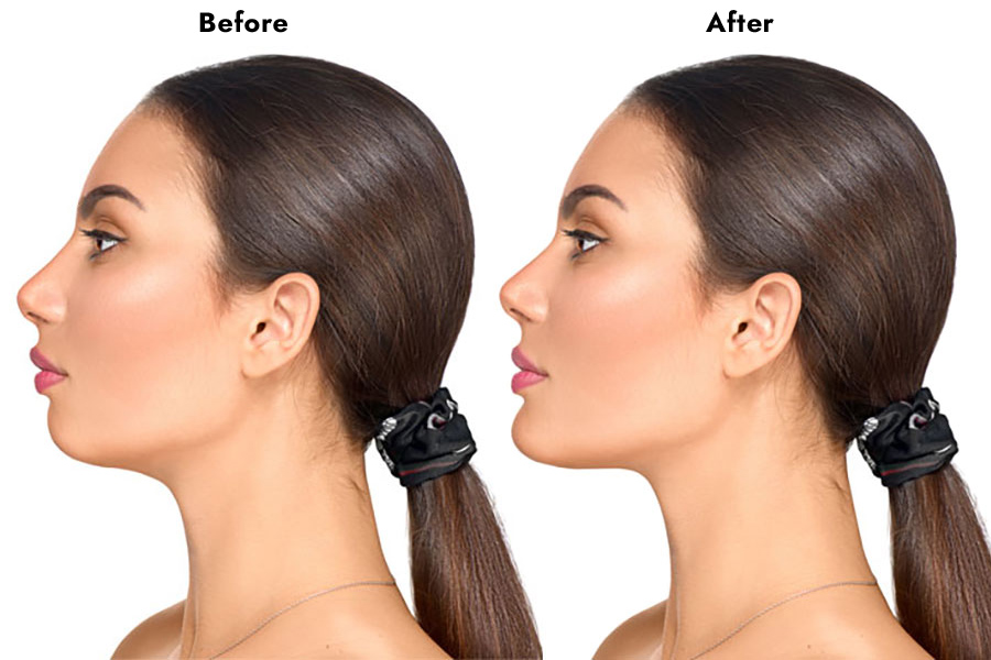 Double Chin of women