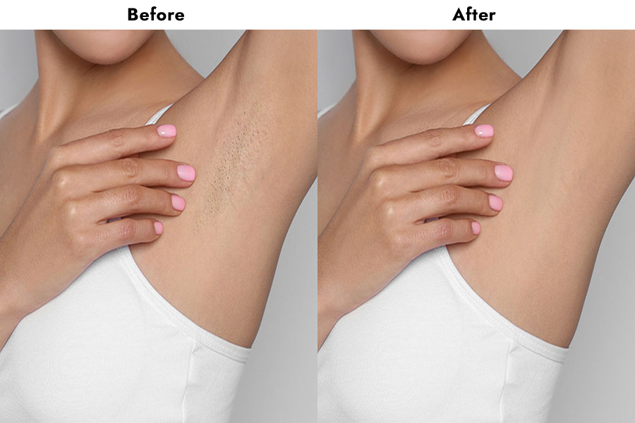 underarm hair removal treatment
