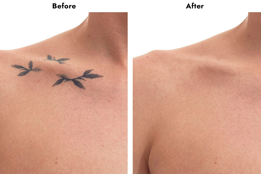 skin tattoo removal