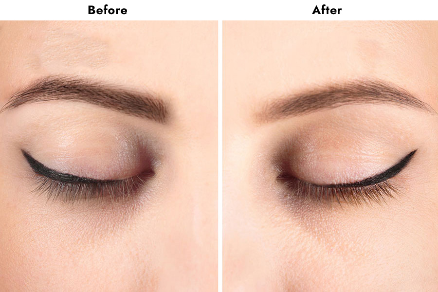eyebrow treatment