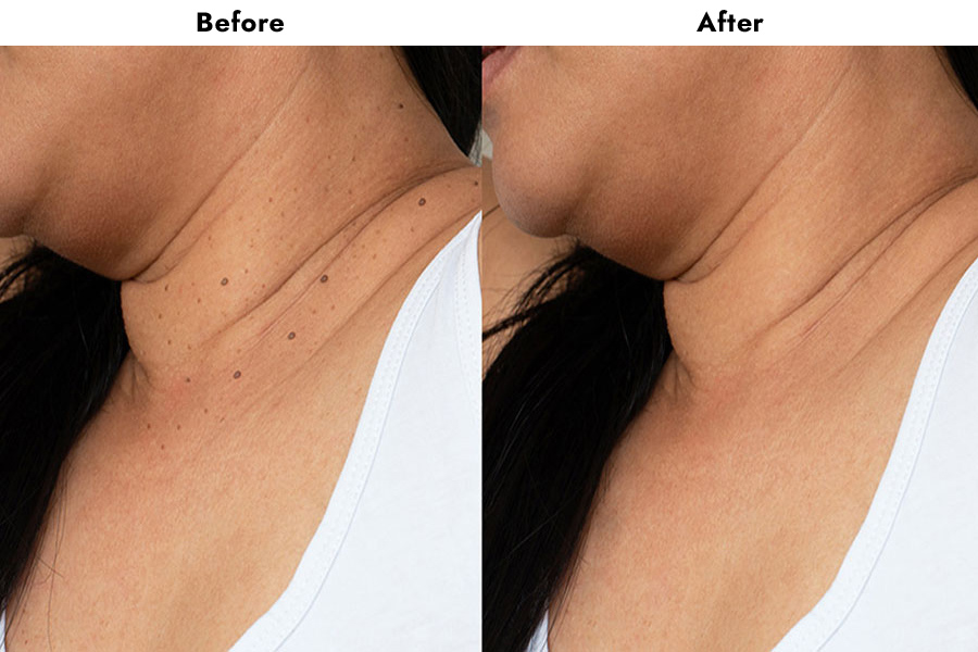 skin tag removal treatment