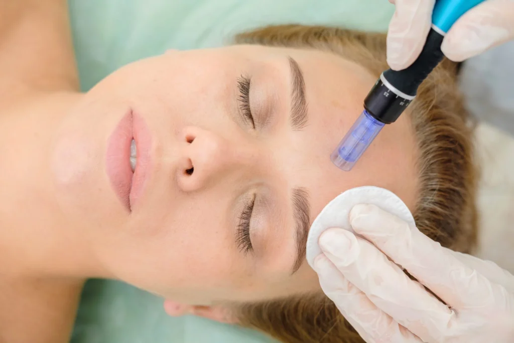 woman getting microneedling treatment