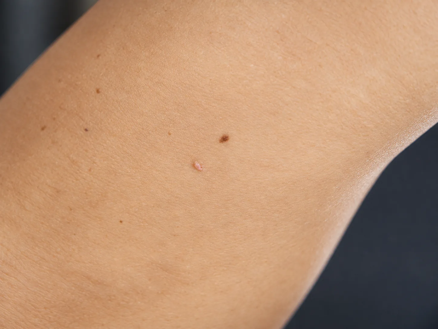 Q-Switch 1064 Laser Rejuvenation at Skinholic Aesthetics & Laser, in the treatment room