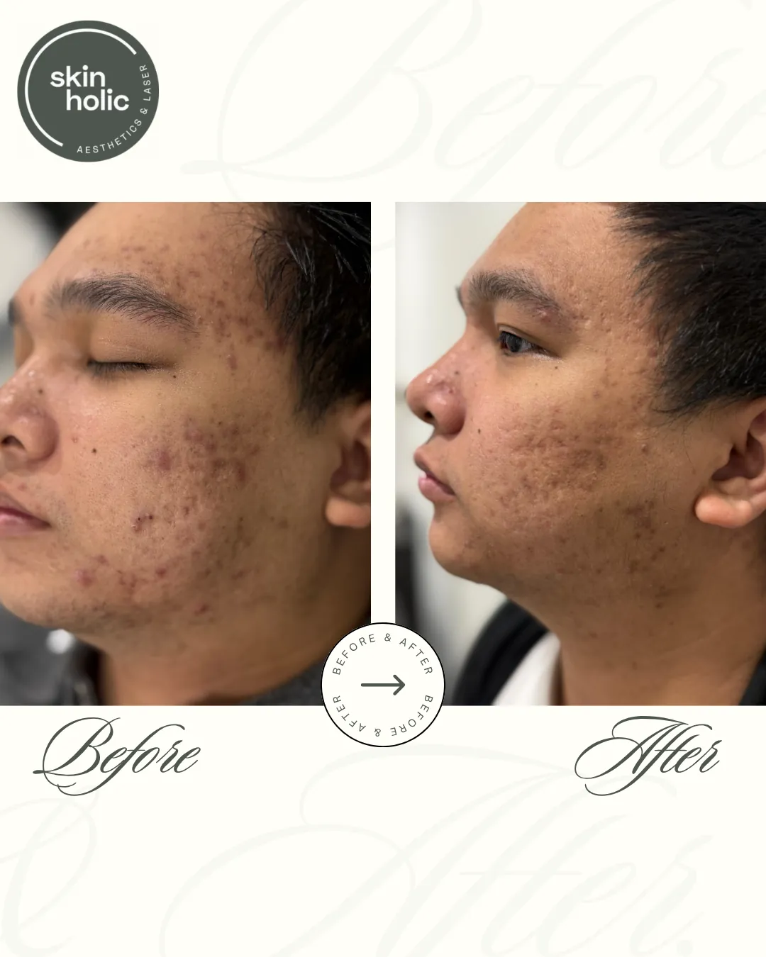 Before and after: Acne and texture, customised facial plan.
