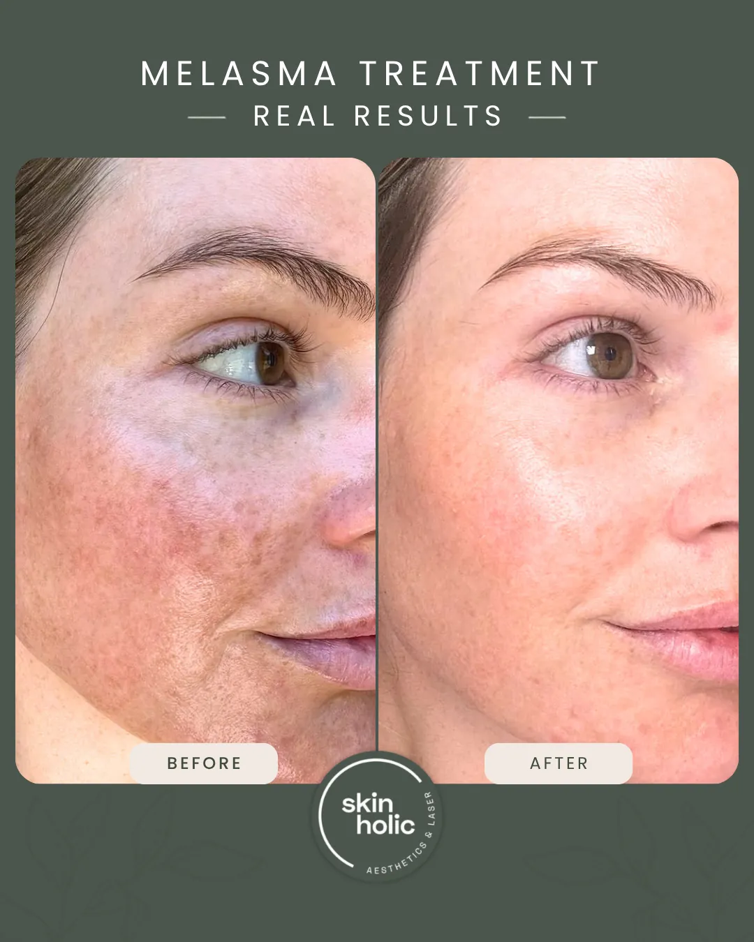 Before and after: Melasma, customised treatment plan.