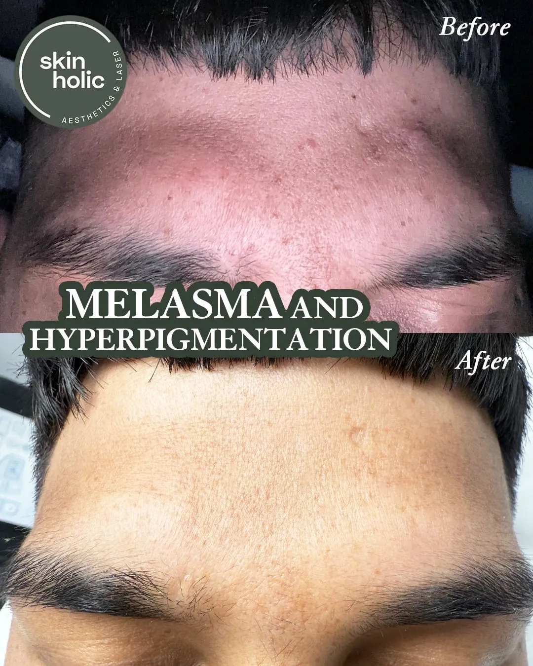 Before and after: Melasma, customised treatment plan.
