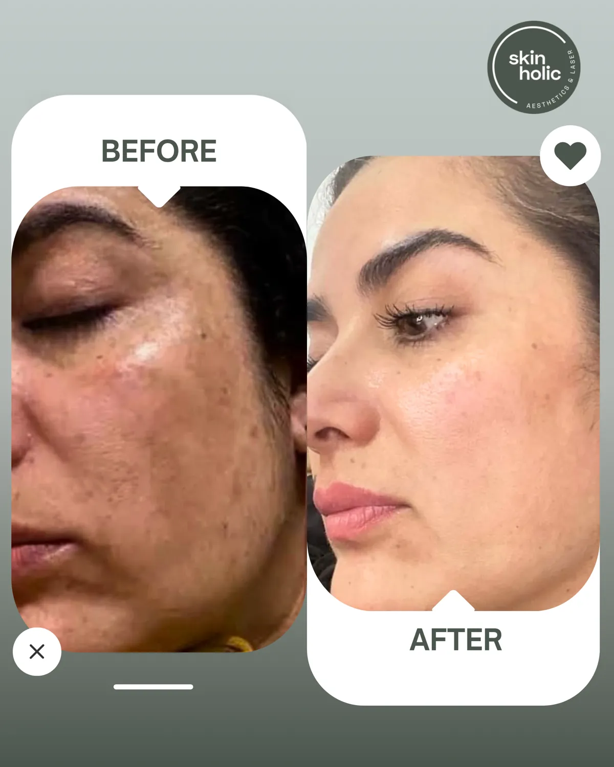 Before and after: Pigmentation.