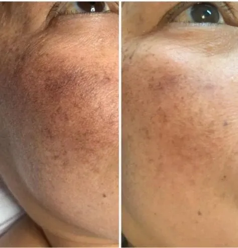 Before and after: Skin lightening.
