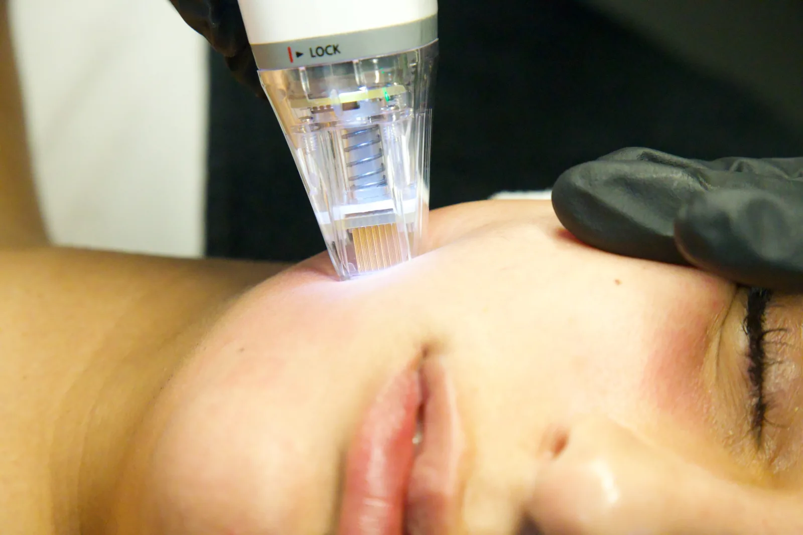 Scar Relaxation at Skinholic Aesthetics & Laser, in the treatment room