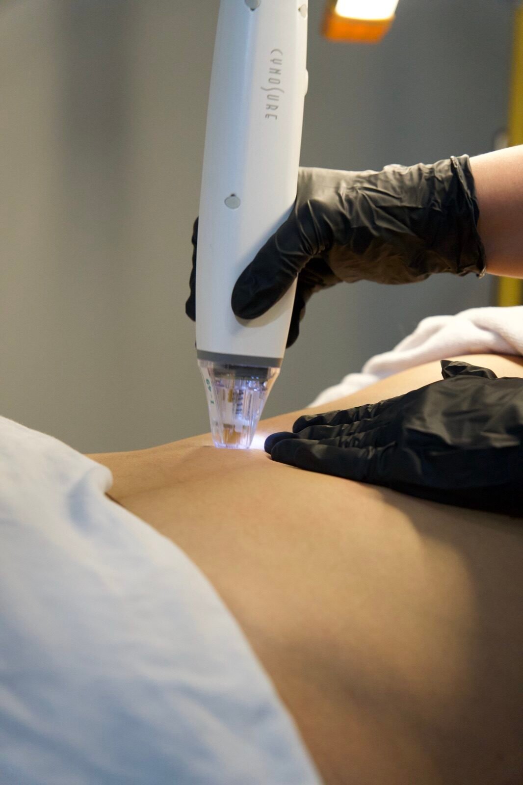 Stretch Mark Reduction at Skinholic Aesthetics & Laser, in the treatment room