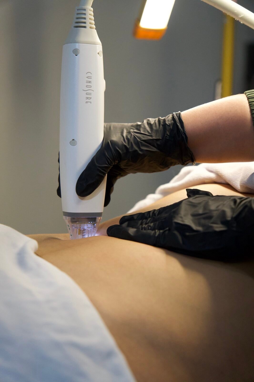 Stretch Mark Reduction at Skinholic Aesthetics & Laser, in the treatment room