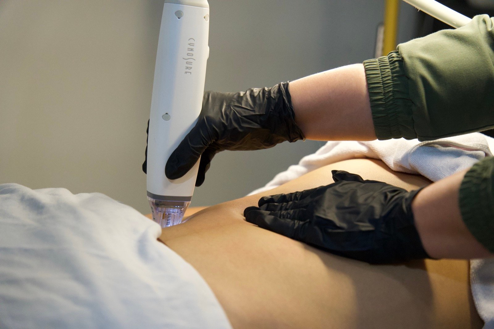 Stretch Mark Reduction at Skinholic Aesthetics & Laser, in the treatment room